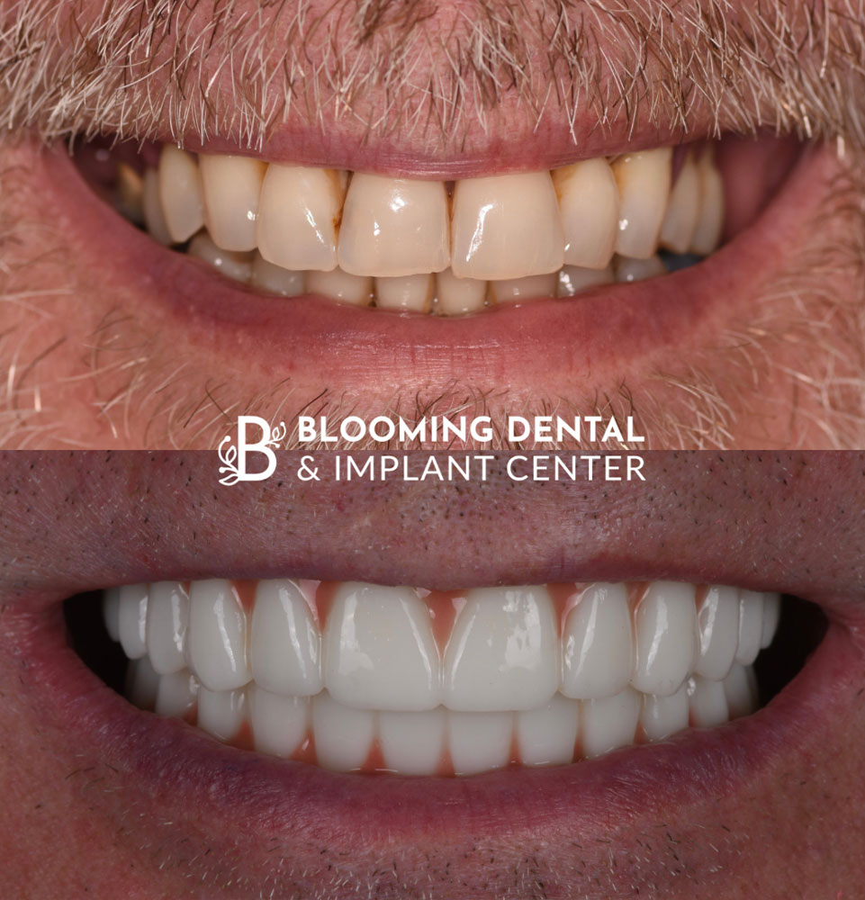 before and after full mouth dental implant