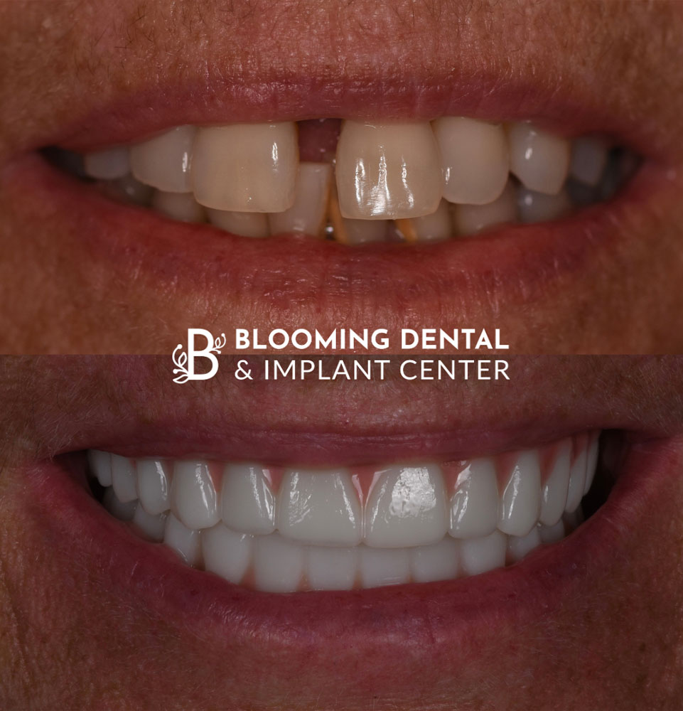 before and after full mouth dental implant
