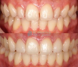 Invisalign and Veneers Before and After