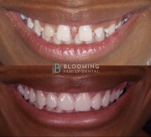 Invisalign and Veneers Before and After